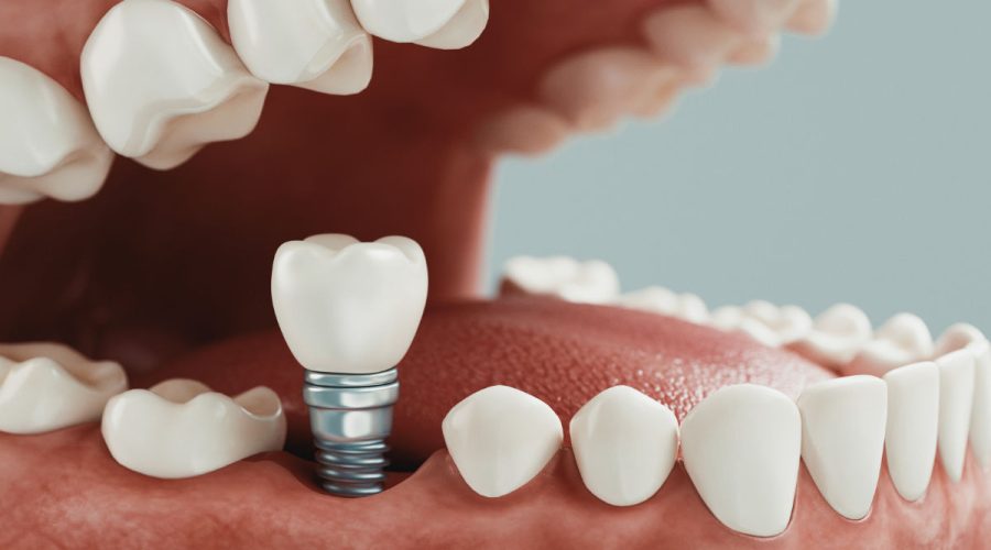 cirugia-con-implantes-dentales-luciano-badanelli-01