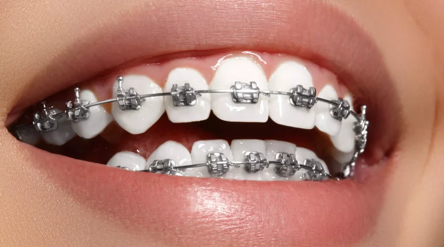ortodoncia en aranjuez